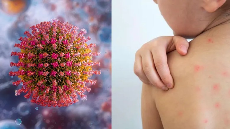 হাম নাকি রুবেলা, বুঝবেন কীভাবে?