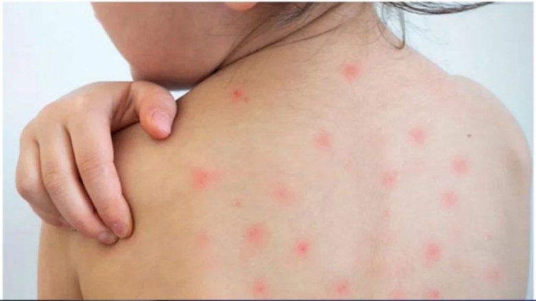 ঢাকাসহ ৪ সিটিতে শুরু হলো বিশেষ হাম-রুবেলা টিকাদান কর্মসূচি