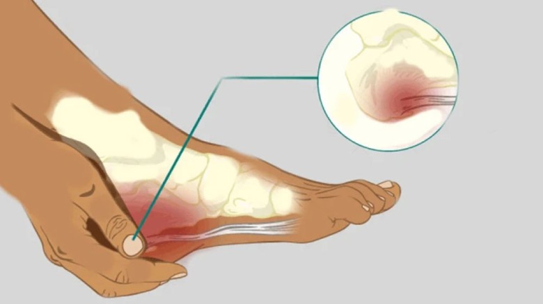 গোড়ালির হাড় বৃদ্ধির কারণ এবং করণীয়