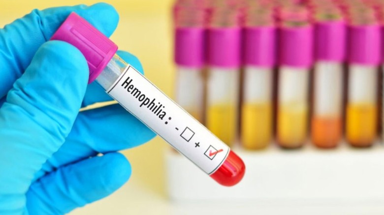 হিমোফিলিয়া: কারণ, লক্ষণ ও করণীয়