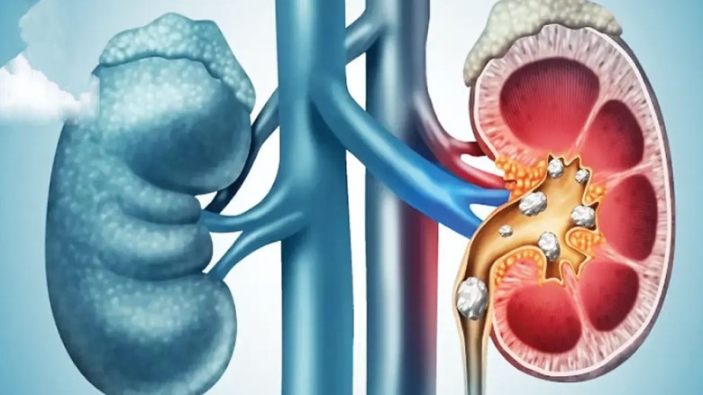 যেসব কারণে মূত্রনালিতে পাথর হতে পারে