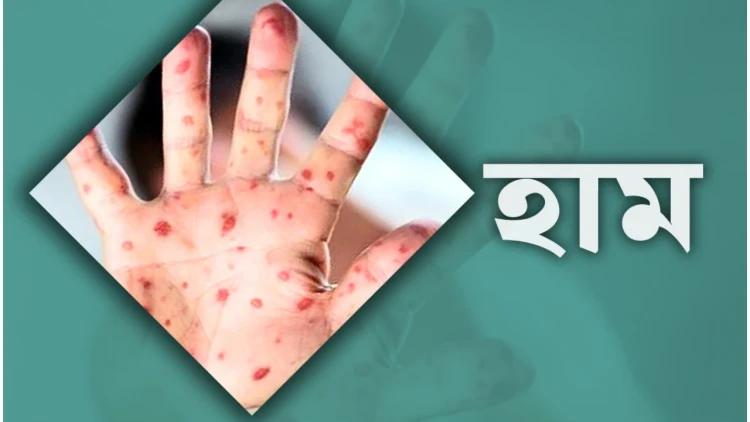 ২৪ ঘণ্টায় হামের উপসর্গে ৩ জনের মৃত্যু, মোট প্রাণহানি ৯২৮