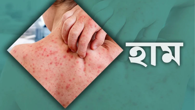হাম উপসর্গে গত ২৪ ঘণ্টায় আরও ৬ জনের মৃত্যু
