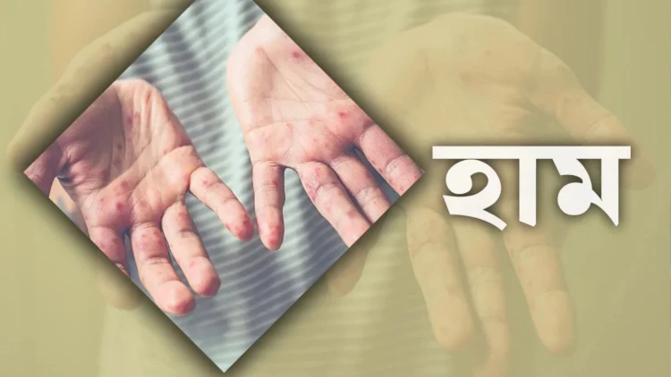 দেশে ২৪ ঘণ্টায় হাম উপসর্গে ৮ জনের মৃত্যু
